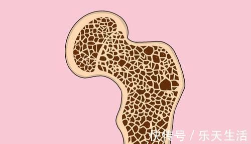 癌症骨转移|癌症出现骨转移，说明已经进入晚期，无法治愈了吗？医生解答了