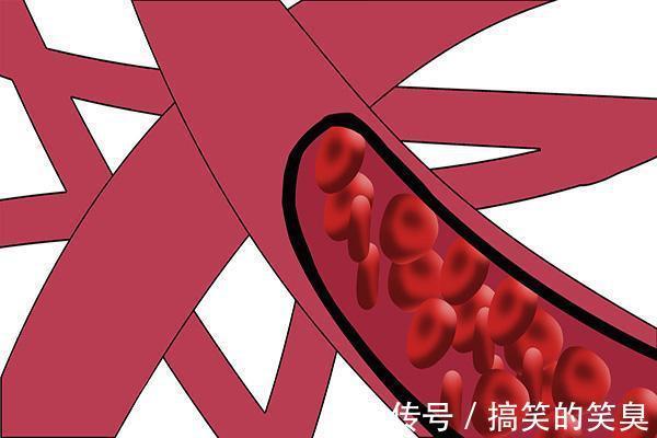 胸闷|血管堵了,身体会发出“求救信号”,晚上会比较明显