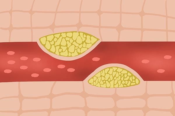 嘌呤|高尿酸是怎么引起的？嘌呤食物并非主因，还和这2种因素有关？