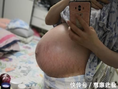 激素|“毁容式”怀孕之妊娠纹:10个孕妈9个长纹,教你咋应对咋预防