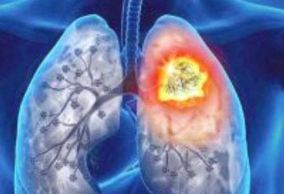生活中|肺是人体最脆弱的器官,如何提高老年人的免疫力,增强肺功能呢?