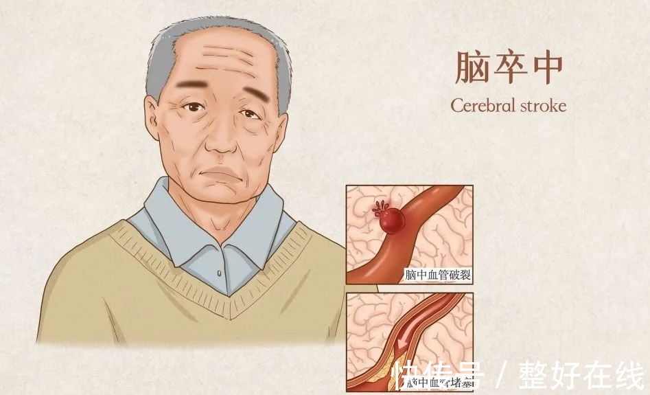 发病率|健康的“头号杀手”脑卒中,俗称中风,引发脑卒中的原因有哪些?
