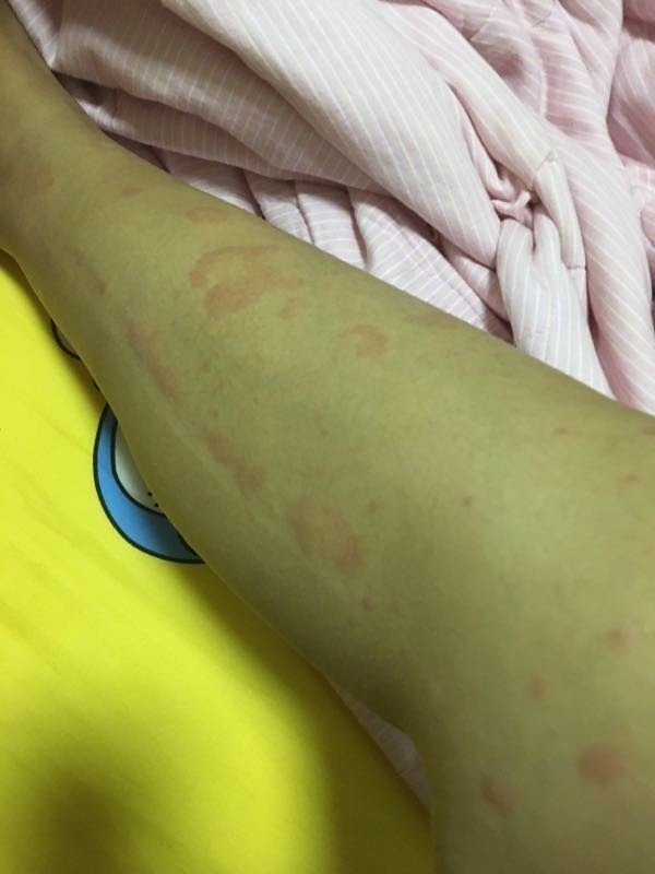 螃蟹|哺乳期吃螃蟹宝宝过敏怎么办?