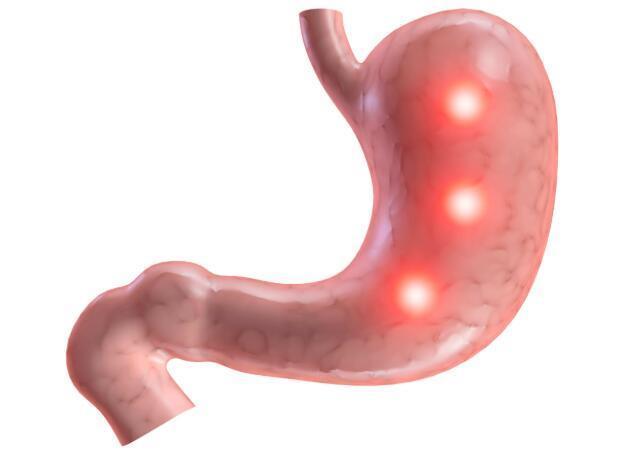 胃病|饭后胃部出现4种不适时,要及时检查,以免“拖”成胃病,别忽视