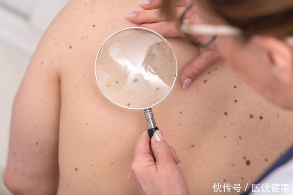 油腻食物|肝癌早期不痛不痒?细心的人若发现4处“异常”,及时检查