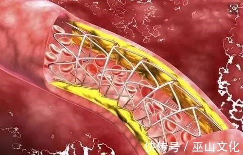 运动|血脂高不高,看小腿就懂若有这4种症状,或在暗示血脂偏高了