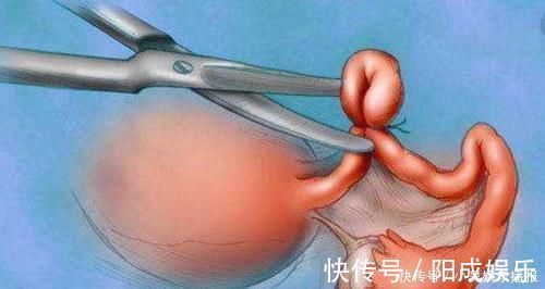 结扎|二胎剖腹产,要顺便“结扎”吗过来人只怪当年不懂里面的门道