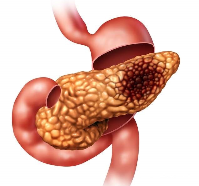 胰腺癌|女子口渴、尿多,以为是糖尿病,直到上腹部不适医生才发现是癌症