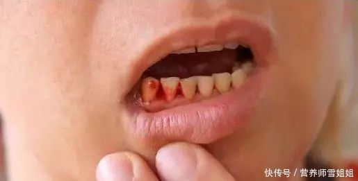  拖延|喝酒的人，出现“1痣、2痛、3多”，去查查肝脏，别忽视拖延