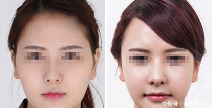 美容店|脸上打“玻尿酸”的女孩子之后怎样了?听美容专家一说全明白