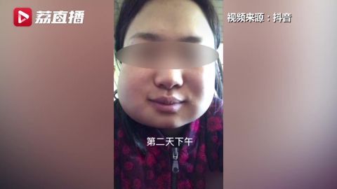 女子连拔3颗智齿肿成松鼠脸 专家称智齿若端正不用拔