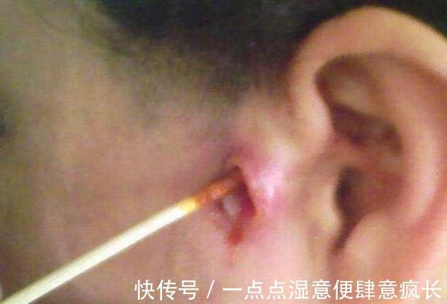 孩子|孩子耳朵旁边长出“聪明孔”,奶奶好奇挤了一下,不料却惹了麻烦