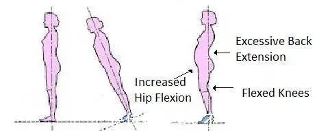 腰部肌肉 穿高跟鞋损伤颈腰椎美丽的代价到底有多大！