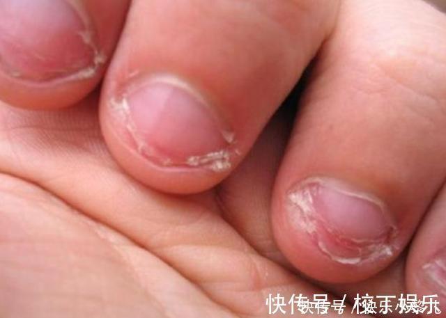 小动作|从小“咬指甲”的孩子,长大后会变成啥样专家逃不过2种结局