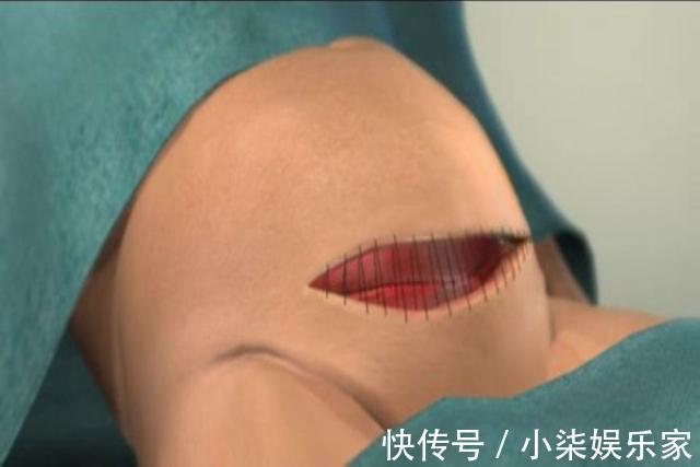 剖腹产|剖腹产最痛是什么时候过来人的说法给你一些参考,孕妇早知道好