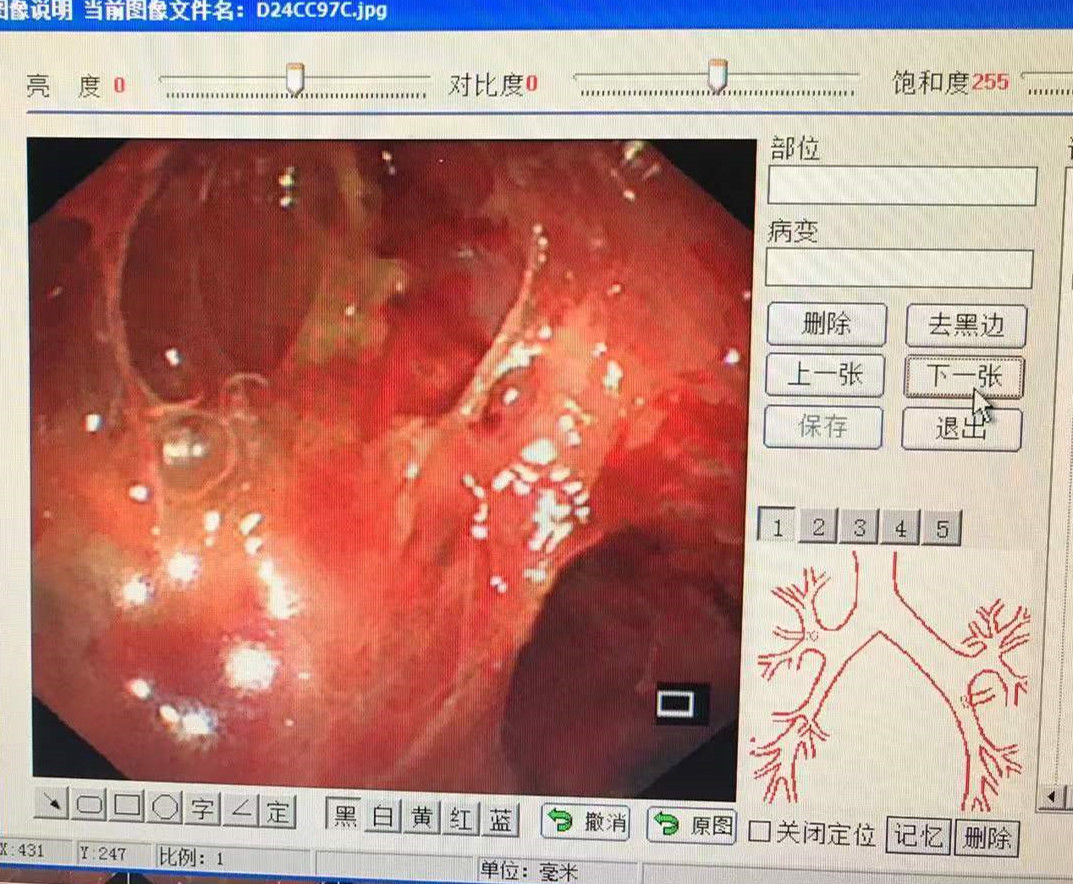 咳喘|“吹水泡、绕蛛网”，怪癖细菌在胸腔“作妖”引发剧烈咳喘，小伙为治病两个月跑了4家医院