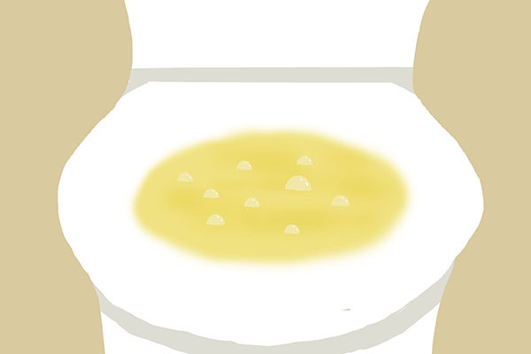 大便|是否得肝病,上厕所时一眼看出来,尿液、粪便的共性,藏不住