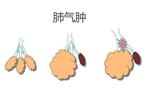 阻塞性|肺气肿病发的原因是什么?