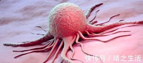 肿瘤|癌症治疗后没一年又复发这些原因是罪魁祸首,患者要注意