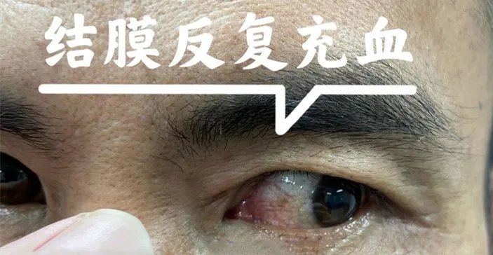 异物|一颗“铁豌豆”在乐东男子眼睛里藏了3年，他竟浑然不知！