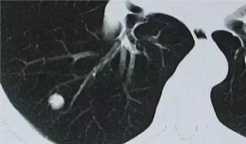 结节|体检发现肺结节，如何进一步检查以排除肺癌大夫建议您这么做！