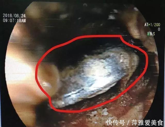 喉咙|小小一枚,孩子喉管被腐蚀!再说一遍,这些东西必须放好了