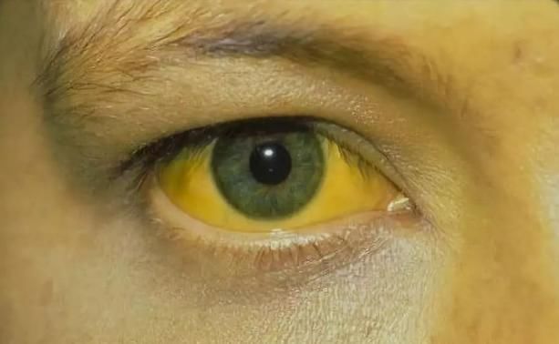迹象|“肝不干净”，眼睛会“说话”，若眼睛有3种“迹象”，肝病来临
