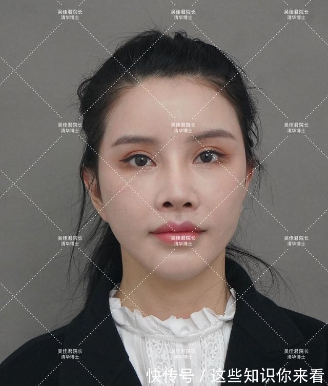 下垂 32岁姑娘小拉皮术后7个半月,变得年轻又精致,前后反差很大!