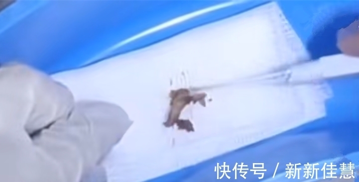 检查|女子半夜耳朵痛,情急之下到医院检查,检查结果让医生笑喷了