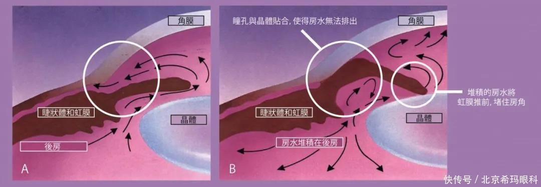 视神经|天冷就头痛,医生却让我去看眼科?