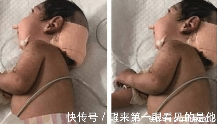 残疾|残疾小孩被父亲残忍掩埋，医生全力救助，心疼!