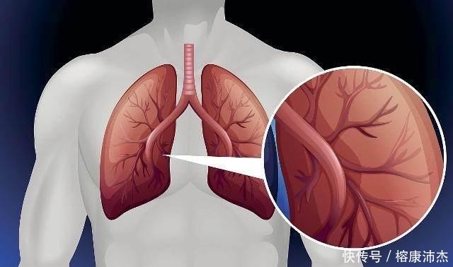  肺部出现|“肺癌”发现多数是中晚期可能早期有这3种“情况”, 不妨一看