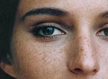 斑点|想祛斑!就要先了解斑是怎么来的!