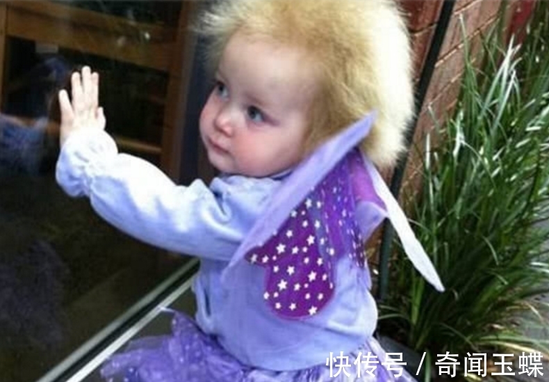 头发|世界上最奇怪的病,患者不能梳头,全球仅有百例,爱因斯坦是其一