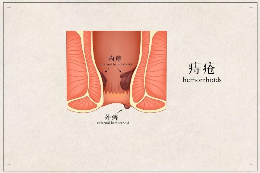 外痔|山西惠民医院：斗“痔”必备小常识请接收！