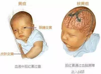 黄疸指数|宝宝得了黄疸，需要停母乳吗