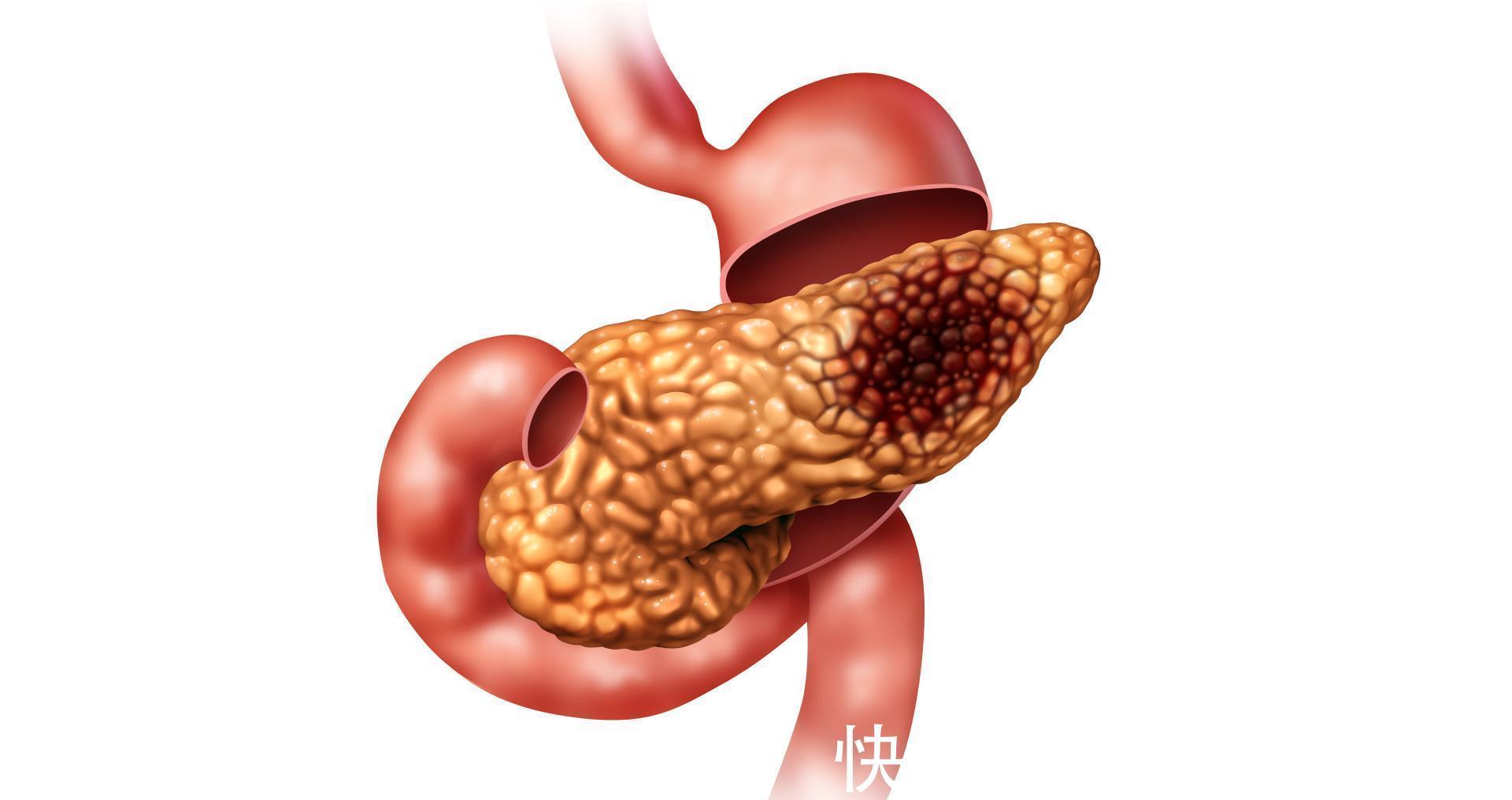 腹痛|胰腺癌被称为“癌王”?有6大类高危人群,有哪些典型的征兆?