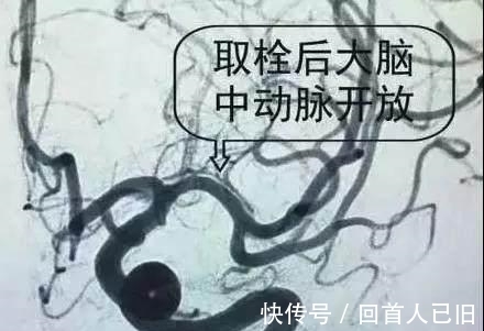 梓醇|中风的“罪魁祸首”是血栓, 记牢两个字血栓不上身