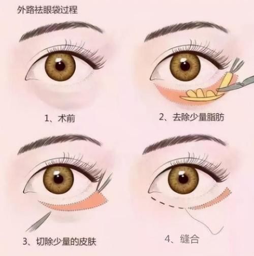 眼袋和黑眼圈是我们的颜值“天敌”！该如何应对？这3招或可参考