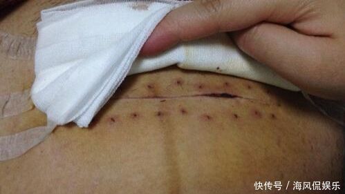 剖腹产会有哪些后遗症，还有什么好处