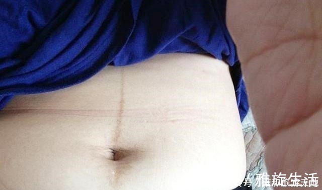 痱子|在怀孕后,女性皮肤上的变化较为明显,这五点看看你有没有中招