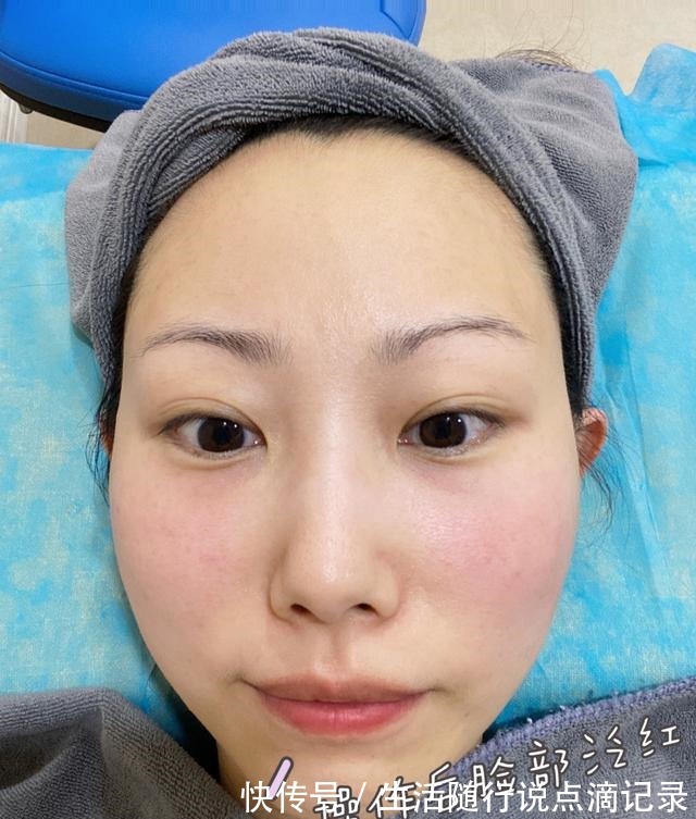 面部 对抗地心引力一直在路上丨面部热玛吉初体验!