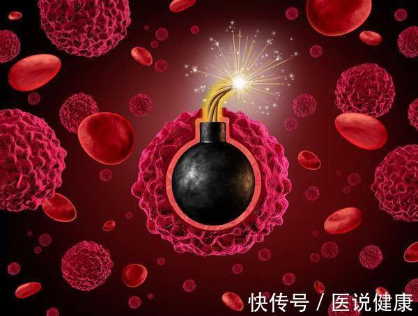 癌症晚期|查出癌症晚期,还要继续治吗?不妨先考虑这3点,再做打算