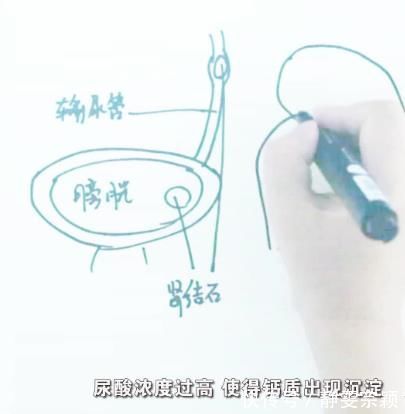 痛风性肾病|尿酸高影响肾功能吗？医生：痛风患者请做好十件事，保肾降尿酸