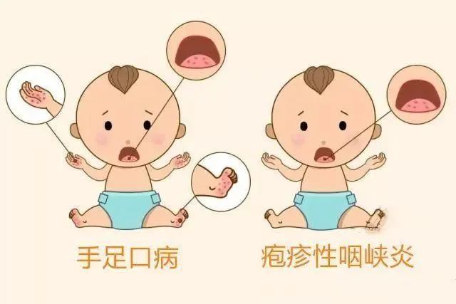 咽痛|防控手足口病同时，疱疹性咽峡炎也别忽视！（一）