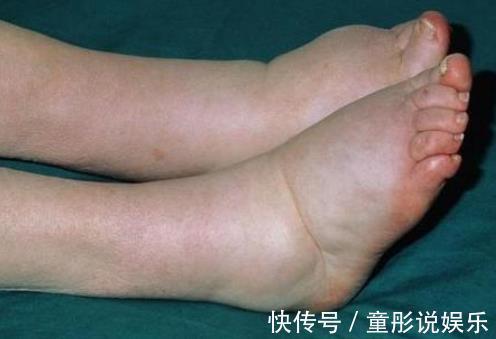 凶手|28岁男子患癌,“凶手”就是这种食物,不要再食用了