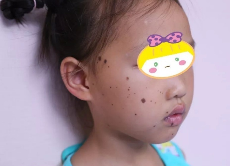 美容院|6岁女孩患上“皮肤癌”，医生检查出诱因，很多家长还在犯