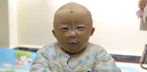 水泡|男孩被开水烫伤,宝妈的做法被全家人反对,送医后反被医生夸赞