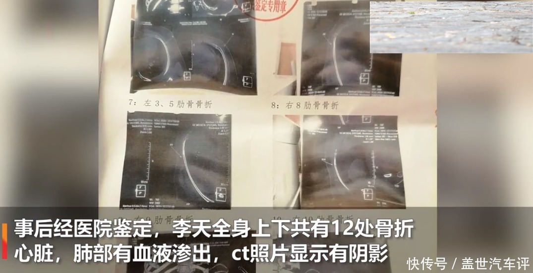 十多人|湖南男子买到发霉食品去更换,反遭十多人围殴,打断12根肋骨