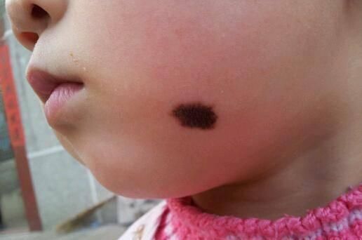 宝宝|孕期,这2件容易让胎宝宝长胎记的事最好别做,不然后悔都来不及